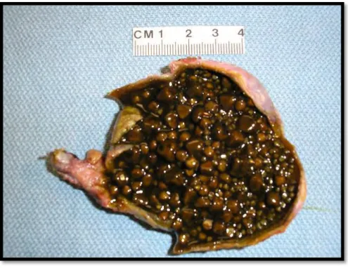 Figure 2: Pigment stones, numerous, brown, irregular, and variable sized.  
