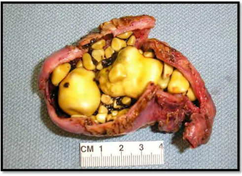 Figure 1: Cholesterol stones, numerous, yellow, irregular, and variable sized 