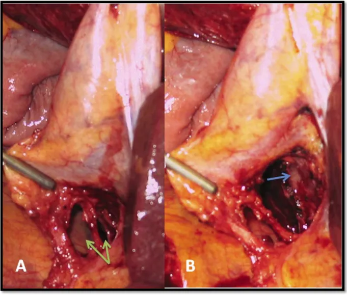 Figure 8: Difference between 2 “windows” and critical view of safety (CVS).  12