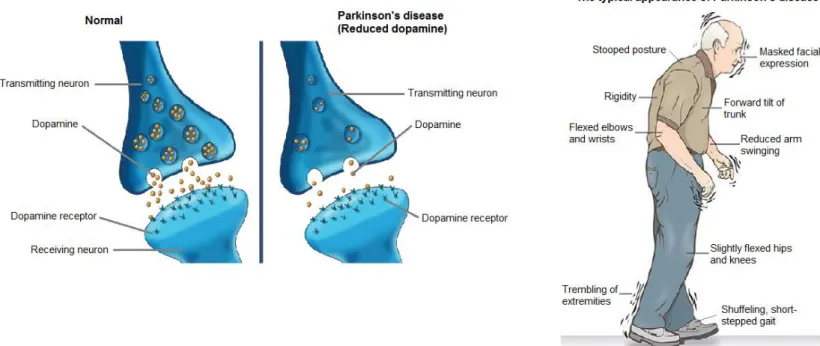 Figure 2.1: A normal vs. a PD dopaminergic neuron and the typical appearance of PD (Massing, 2016)